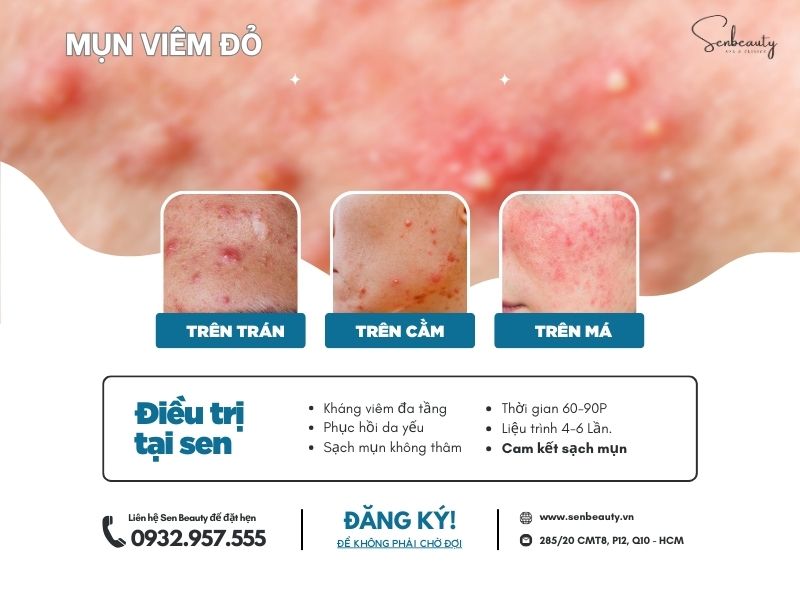 Trị các loại mụn nhọt trứng cá có cam kết